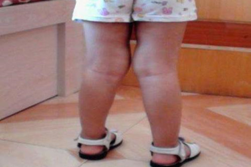 新生儿膝关节反屈图片图片