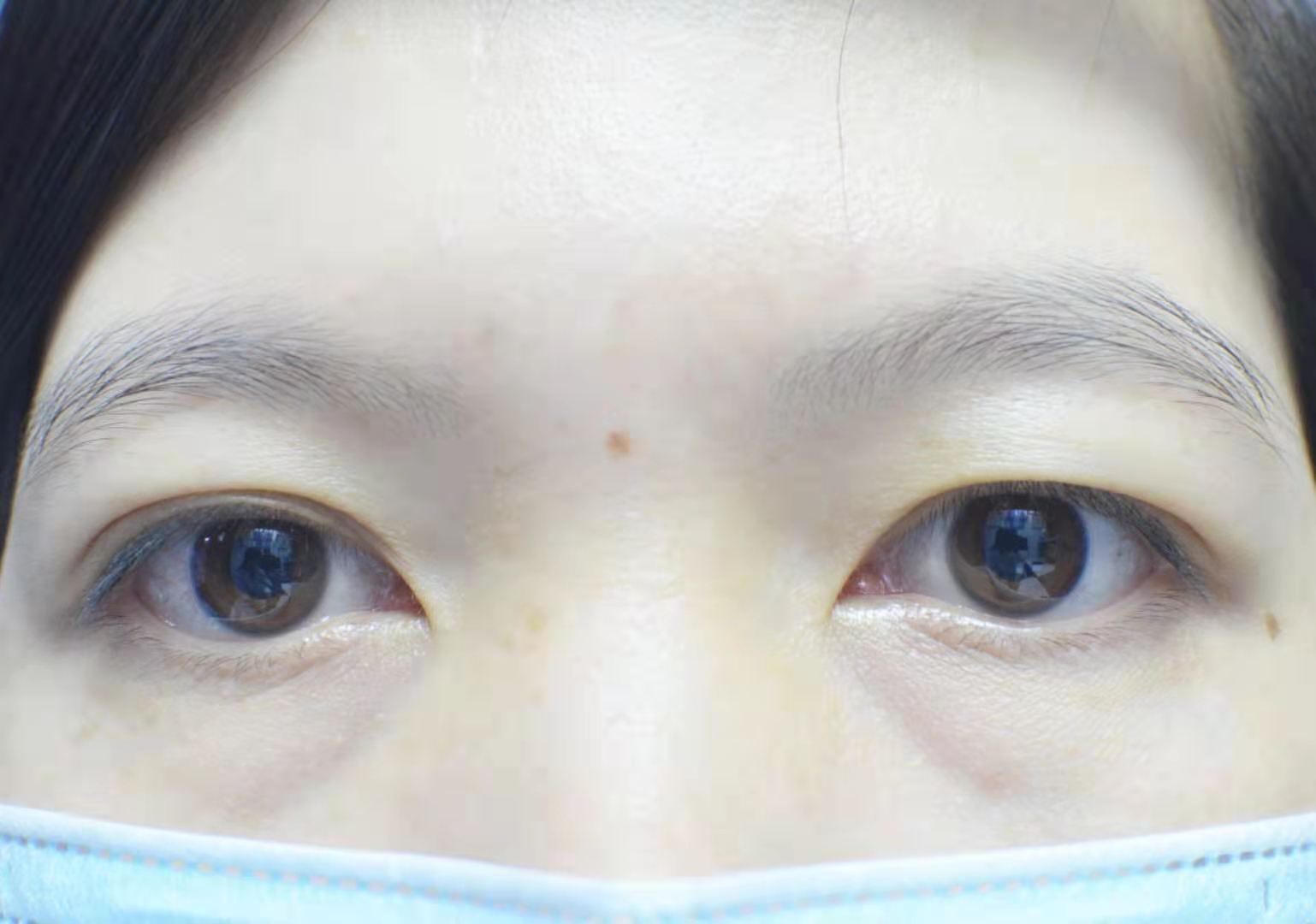 肿眼泡全切双眼皮 去脂去皮 双眼皮，开眼角 记录一下 。（照片有点吓人）手术医生一定要多了解！！！ - 知乎