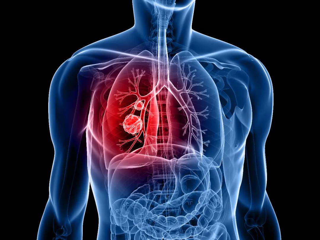 Discovery of distinct lung cancer pathways may lead to more targeted ...