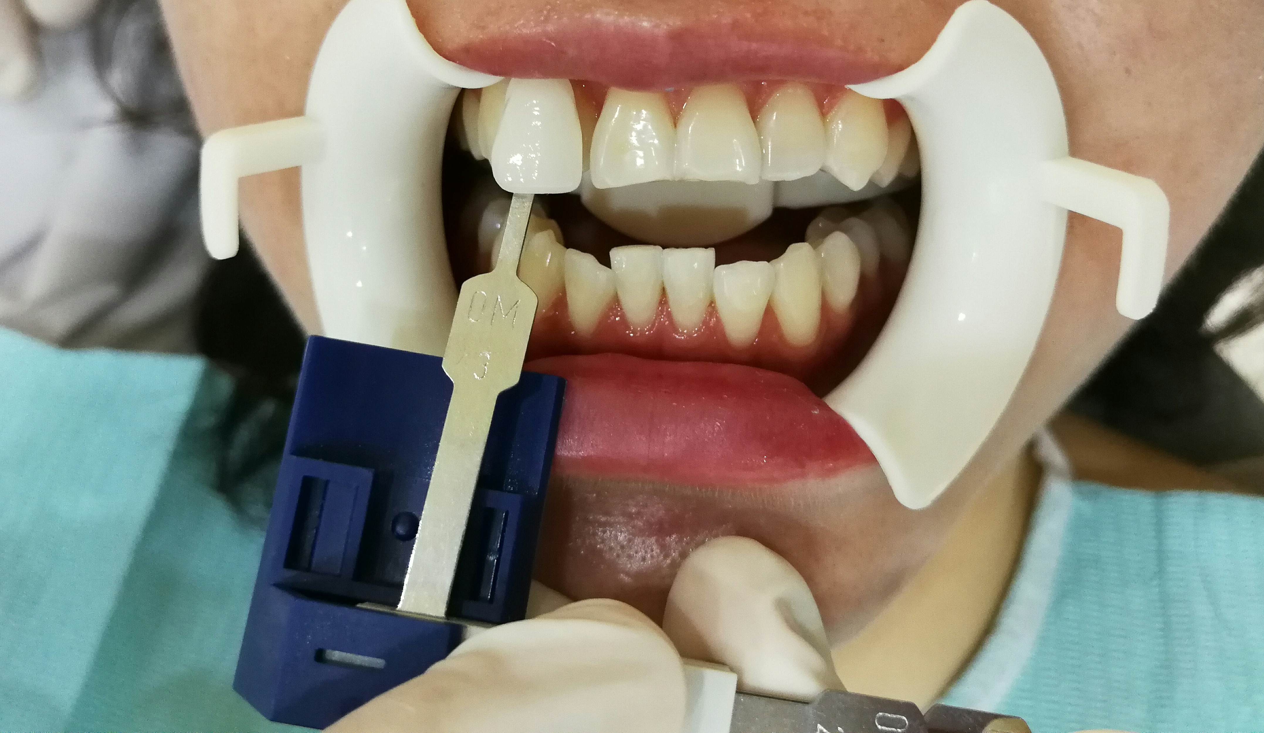 牙齒美白 - 高雄鳳山牙醫診所 | 壹八八美學牙醫