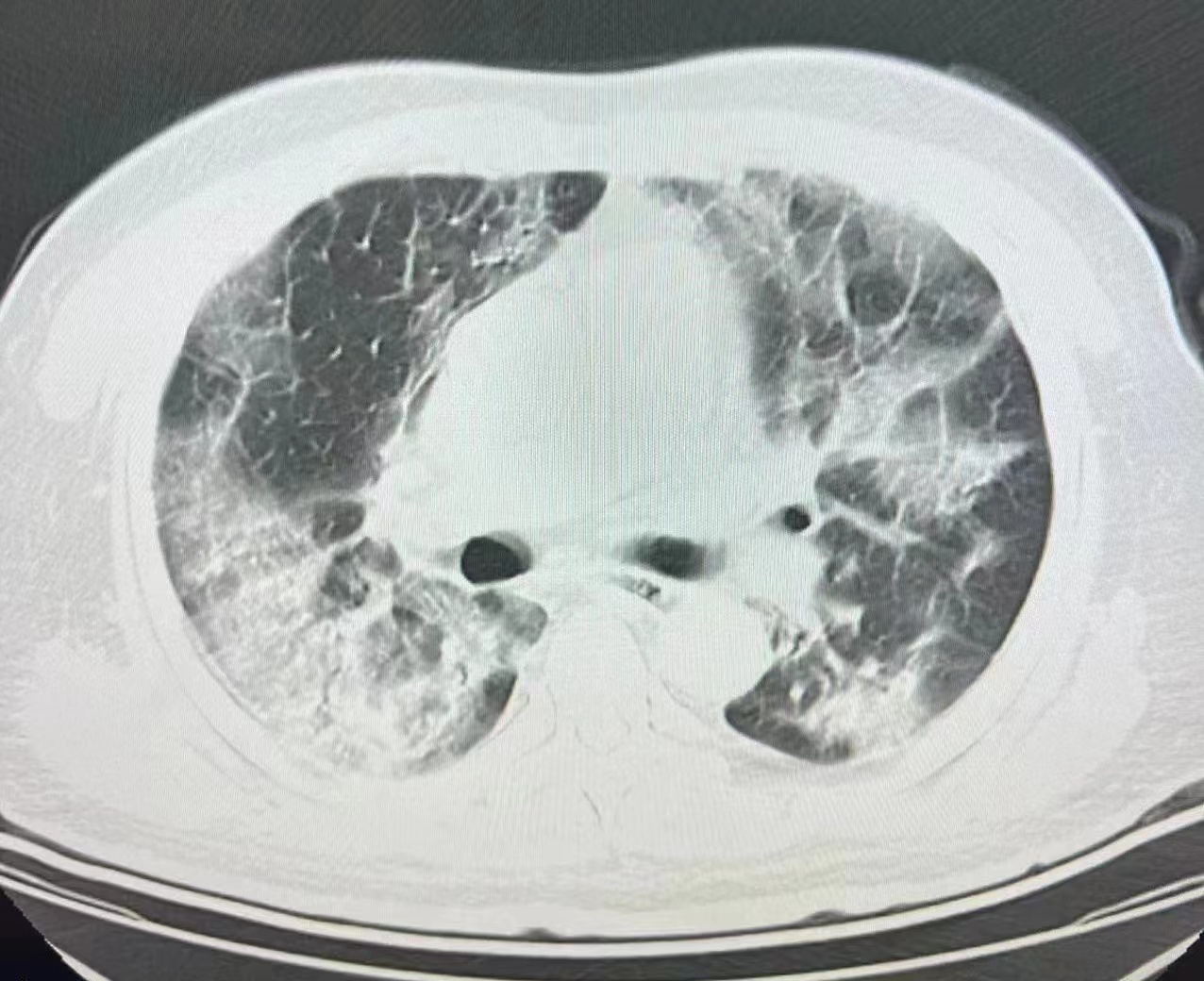 图2—587 心包积液-胸部X线影像学图鉴-医学