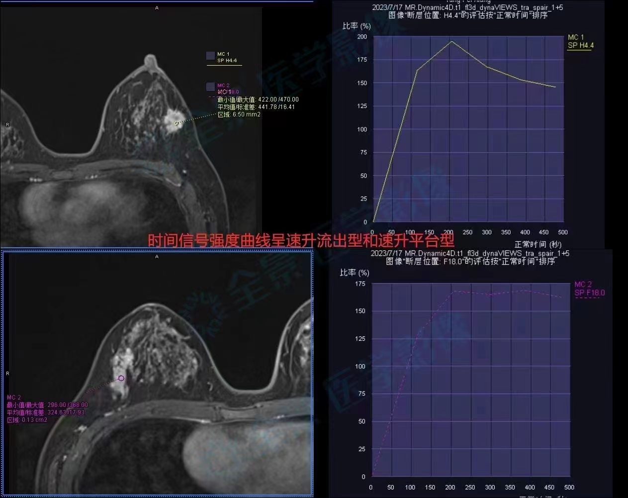 乳腺病变磁共振基本征象分析与诊断进展_检查